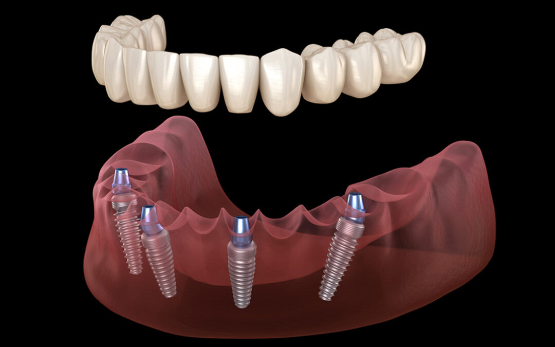 What are All-On-4® Dental Implants?