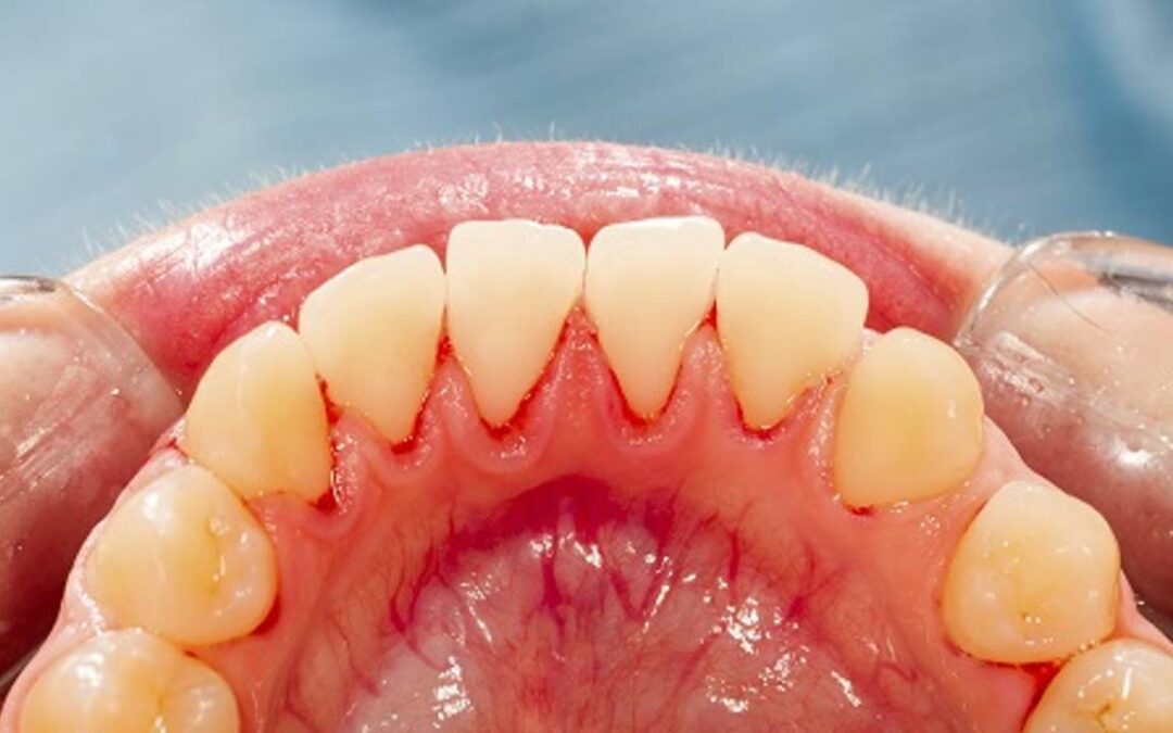 Lumps On Your Gums Are Not Always Dangerous