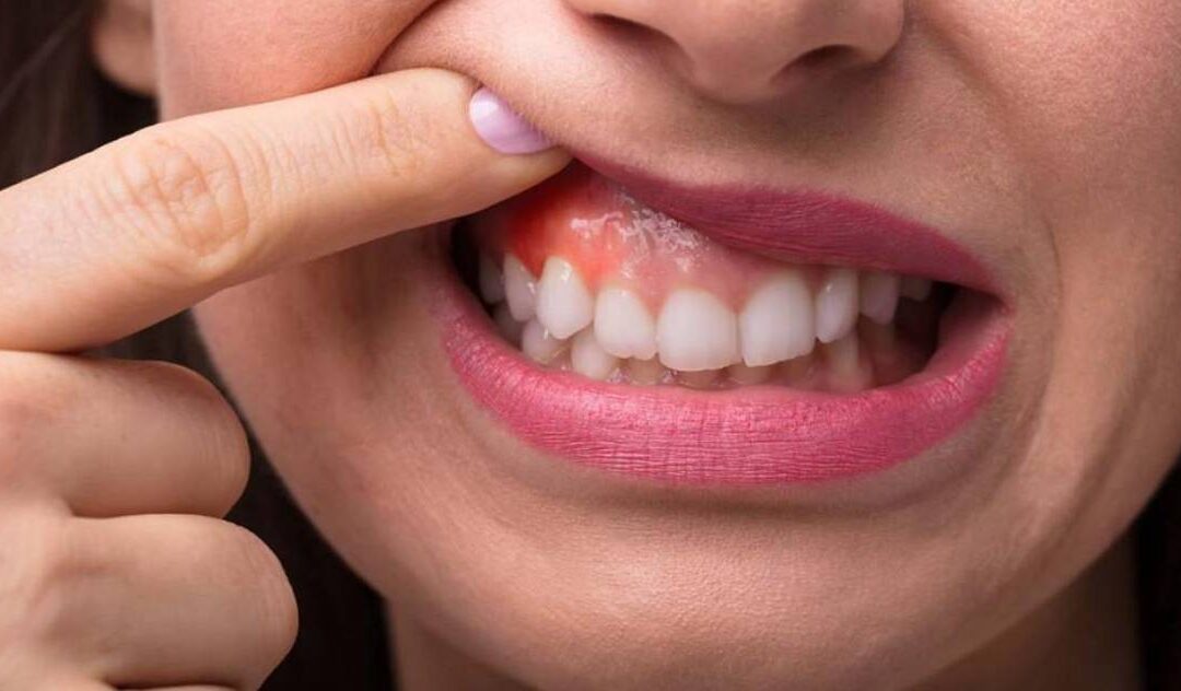 What is the First Stage of Gum Disease and Its Symptoms?