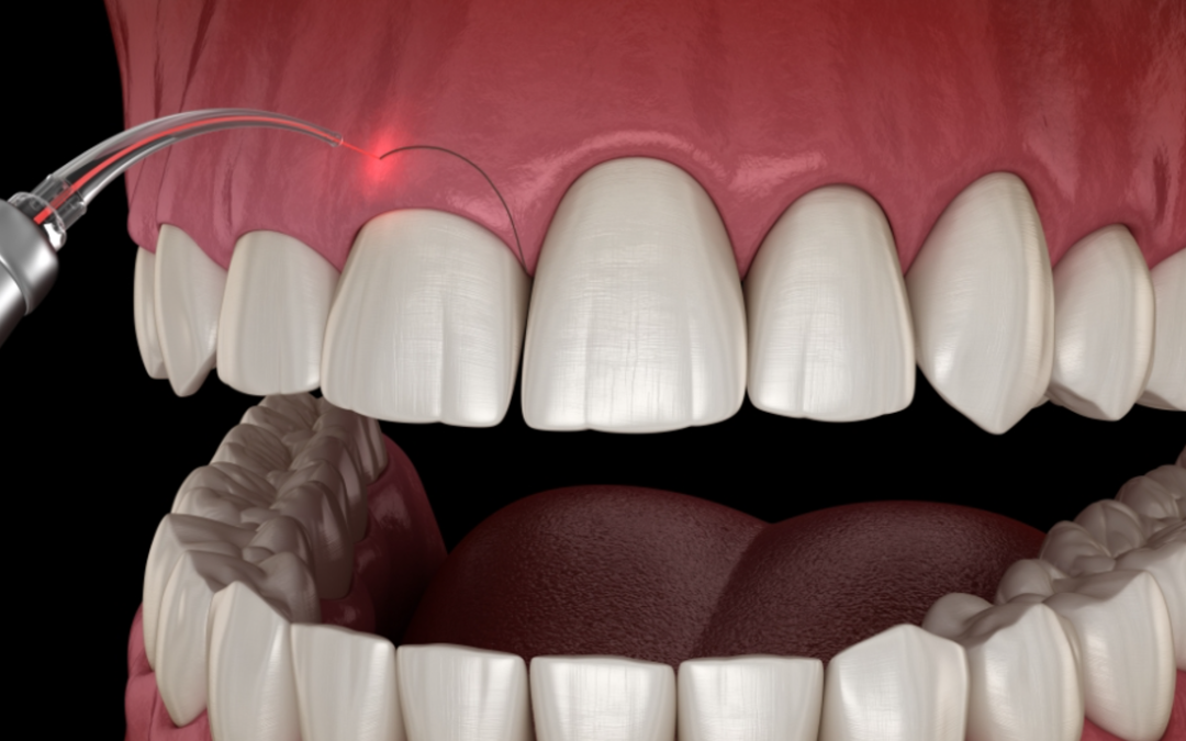 Gingivectomy: What You Need to Know