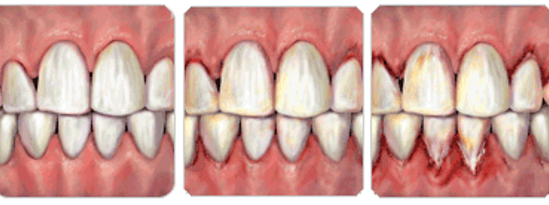 Identifying and Treating the Different Stages of Periodontitis