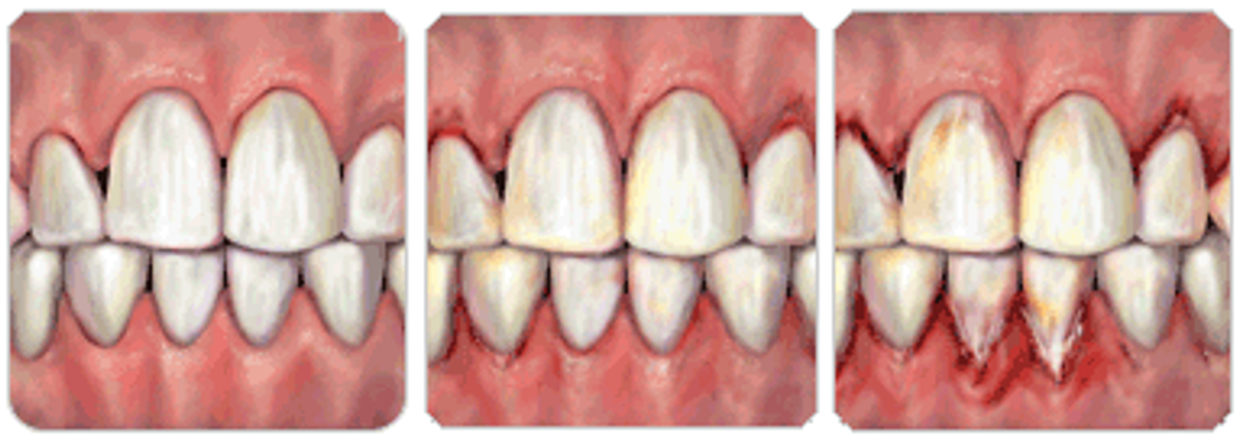 stages of gum disease
