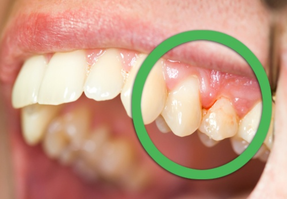 man's mouth with gum inflammation