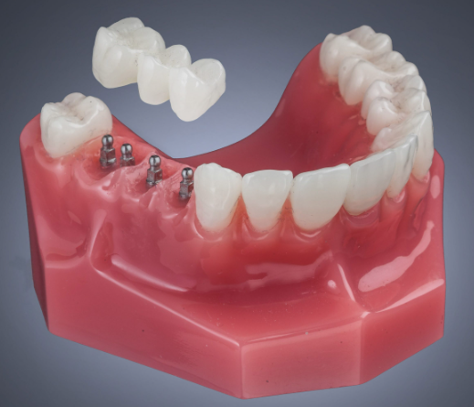 model of mini dental implant supported bridge