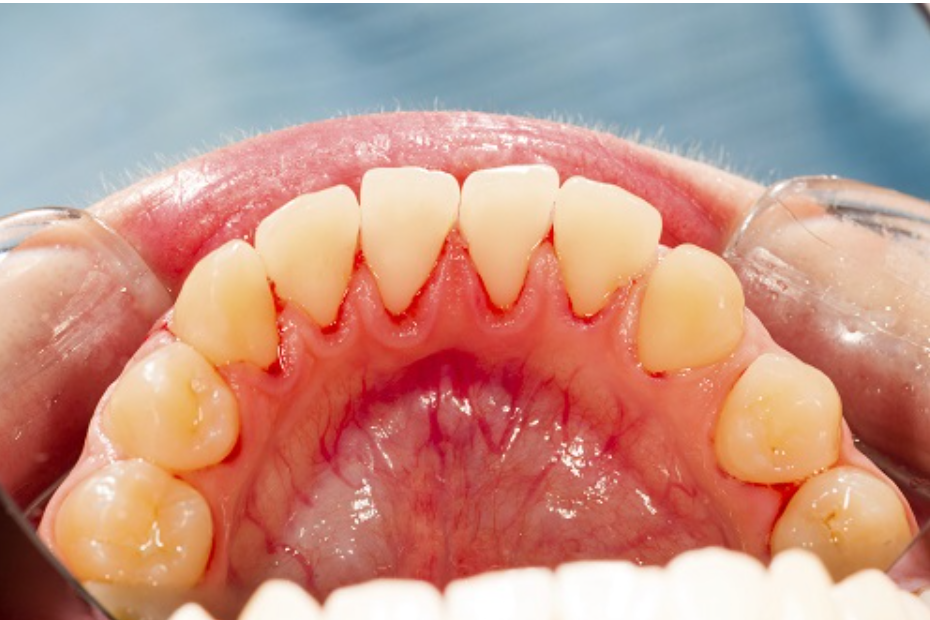 Common Gum Disease Myths