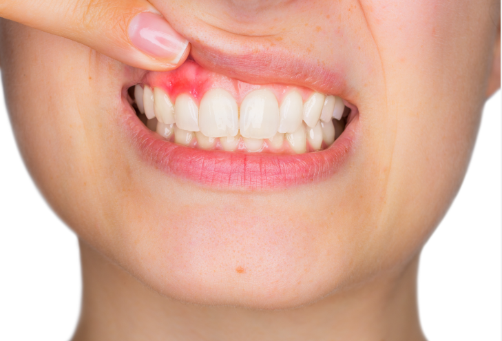 Understanding the Link between Mucositis and Peri-implantitis: The Culprits behind Dental Implant Failure