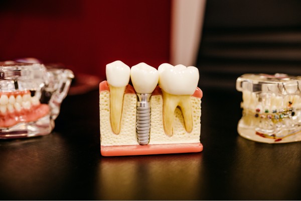 periodontal dental implant model