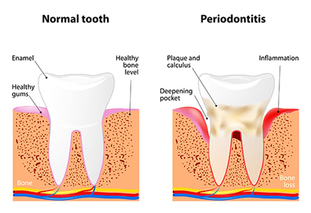 Advanced Gum Disease is Called Periodontitis